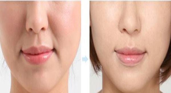 做激光<a href=http://www.bolangguoji.com/listinfo-792-0.html target=_blank class=infotextkey>去法令紋</a>副作用