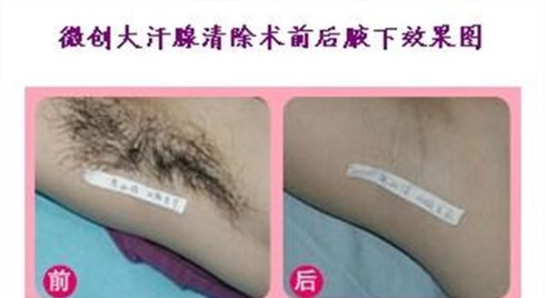 電離子<a href=http://www.bolangguoji.com/listinfo-766-0.html target=_blank class=infotextkey>去腋臭</a>手術的方法是什么？
