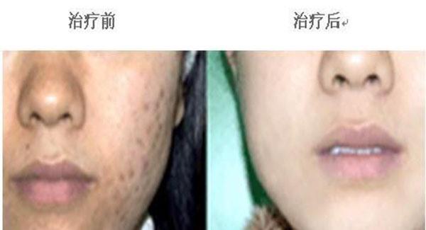 做冷凍治療<a href=http://www.bolangguoji.com/listinfo-797-0.html target=_blank class=infotextkey>去痘疤</a>副作用