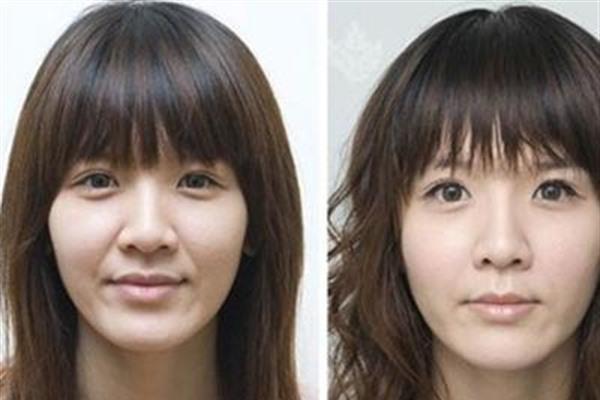 做光子<a href=http://www.bolangguoji.com/listinfo-792-0.html target=_blank class=infotextkey>去法令紋</a>費用大概需要多少