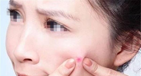 有效快速的祛痘小妙招讓不在為痘痘煩惱