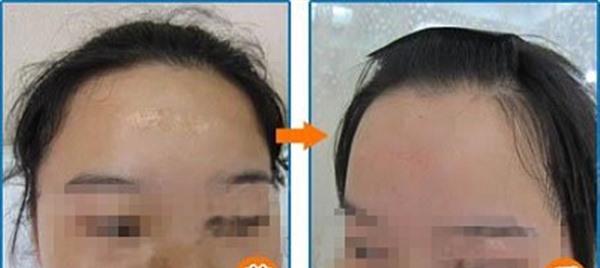 比較成熟的像素激光技術治療范圍有哪些