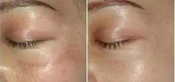 激光去除黃褐斑的方法真的有效嗎