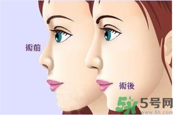 <a href=http://www.bolangguoji.com/listinfo-731-0.html target=_blank class=infotextkey>玻尿酸</a><a href=http://www.bolangguoji.com/listinfo-737-0.html target=_blank class=infotextkey>隆鼻</a>的缺點是什么？<a href=http://www.bolangguoji.com/listinfo-731-0.html target=_blank class=infotextkey>玻尿酸</a><a href=http://www.bolangguoji.com/listinfo-737-0.html target=_blank class=infotextkey>隆鼻</a>的優點有哪些？