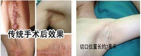 冷凍<a href=http://www.bolangguoji.com/listinfo-784-0.html target=_blank class=infotextkey>去狐臭</a>麻醉方式是什么？