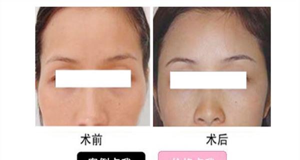 自體脂肪<a href=http://www.bolangguoji.com/listinfo-797-0.html target=_blank class=infotextkey>去痘疤</a>麻醉方式是什么？