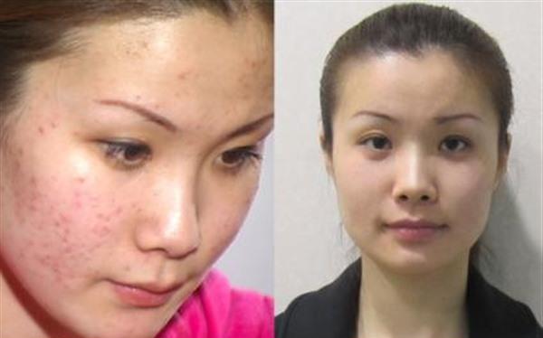 做E光祛痘價格要多少