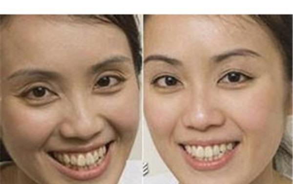 做額顳部<a href=http://www.bolangguoji.com/listinfo-614-0.html target=_blank class=infotextkey>除皺</a><a href=http://www.bolangguoji.com/listinfo-780-0.html target=_blank class=infotextkey>去魚尾紋</a>價格