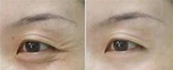 激光除魚尾紋維持時間是多久？