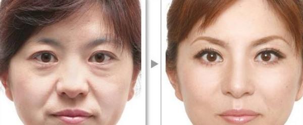 E光<a href=http://www.bolangguoji.com/listinfo-780-0.html target=_blank class=infotextkey>去魚尾紋</a>效果怎么樣？