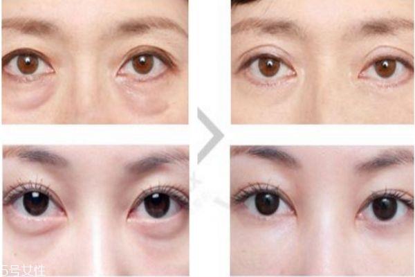 眼袋內切好還是外切好 <a href=http://www.bolangguoji.com/listinfo-708-0.html target=_blank class=infotextkey>去眼袋</a>內切和外切區別