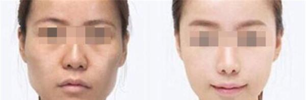 做E光美白不適應人群有哪些