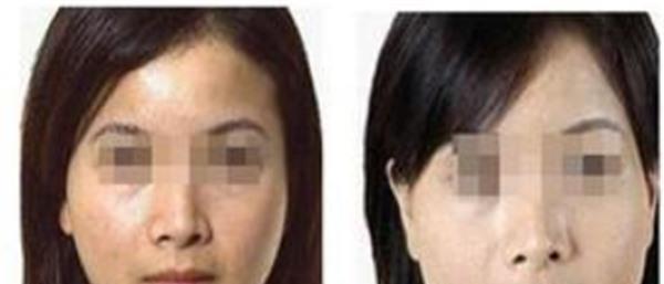 做自體脂肪<a href=http://www.bolangguoji.com/listinfo-797-0.html target=_blank class=infotextkey>去痘疤</a>價格多少錢