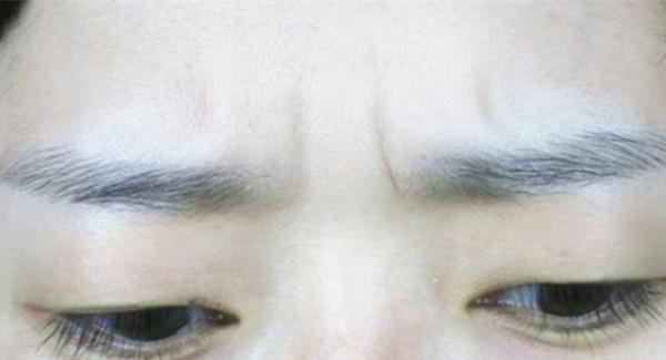 做激光除眉間紋價(jià)格是多少