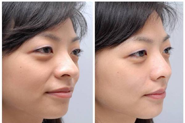 <a href=http://www.bolangguoji.com/listinfo-734-0.html target=_blank class=infotextkey>愛貝芙</a><a href=http://www.bolangguoji.com/listinfo-792-0.html target=_blank class=infotextkey>去法令紋</a>手術(shù)術(shù)后護(hù)理？