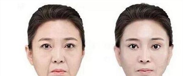 做自體脂肪<a href=http://www.bolangguoji.com/listinfo-792-0.html target=_blank class=infotextkey>去法令紋</a>多少錢