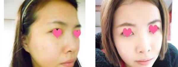 <a href=http://www.bolangguoji.com/listinfo-768-0.html target=_blank class=infotextkey>微針</a><a href=http://www.bolangguoji.com/listinfo-770-0.html target=_blank class=infotextkey>嫩膚</a>手術(shù)安全嗎？