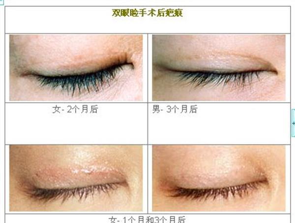 眼瞼疤痕修復多久能恢復？