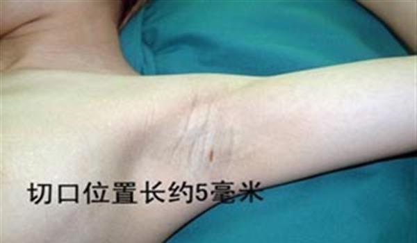 電離子<a href=http://www.bolangguoji.com/listinfo-784-0.html target=_blank class=infotextkey>去狐臭</a>手術(shù)術(shù)后護(hù)理？
