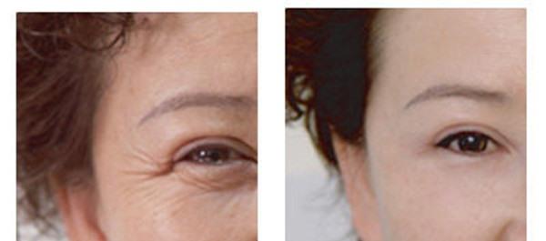 果酸換膚<a href=http://www.bolangguoji.com/listinfo-782-0.html target=_blank class=infotextkey>去眼角細(xì)紋</a>多少錢(qián)？