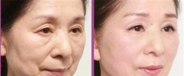 做青春解碼儀美膚不適應(yīng)人群有哪些