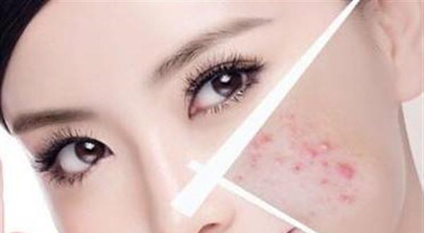做<a href=http://www.bolangguoji.com/listinfo-613-0.html target=_blank class=infotextkey>射頻</a><a href=http://www.bolangguoji.com/listinfo-768-0.html target=_blank class=infotextkey>微針</a><a href=http://www.bolangguoji.com/listinfo-797-0.html target=_blank class=infotextkey>去痘疤</a>費用要多少