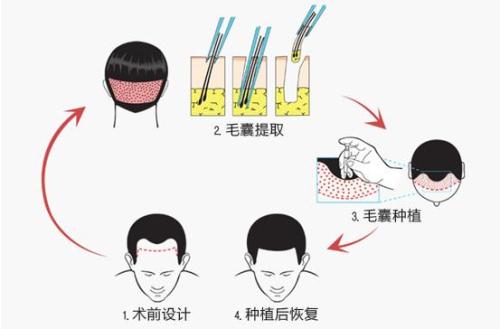 自體<a href=http://www.bolangguoji.com/listinfo-664-0.html target=_blank class=infotextkey>毛發種植</a>多少錢 自體<a href=http://www.bolangguoji.com/listinfo-664-0.html target=_blank class=infotextkey>毛發種植</a>哪一步最關鍵