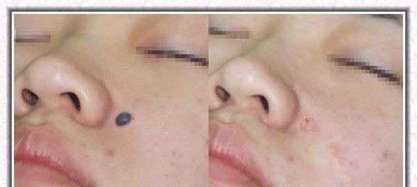 E光點痣適應癥狀是什么？