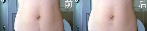 剖腹產疤痕修復要多少錢？