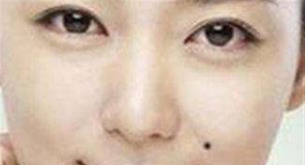 痣相去除多少錢