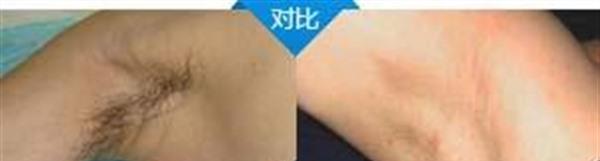 做冷凍<a href=http://www.bolangguoji.com/listinfo-784-0.html target=_blank class=infotextkey>去狐臭</a>多少錢