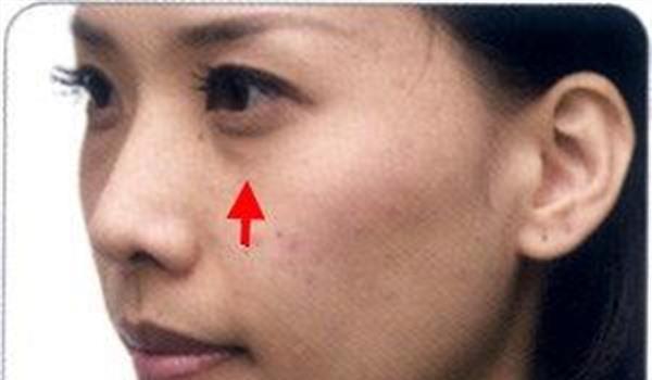 做透明質酸<a href=http://www.bolangguoji.com/listinfo-797-0.html target=_blank class=infotextkey>去痘疤</a>效果好不好