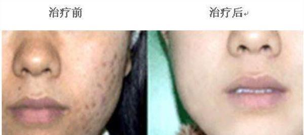 <a href=http://www.bolangguoji.com/listinfo-779-0.html target=_blank class=infotextkey>治療痤瘡</a>手術安全嗎？