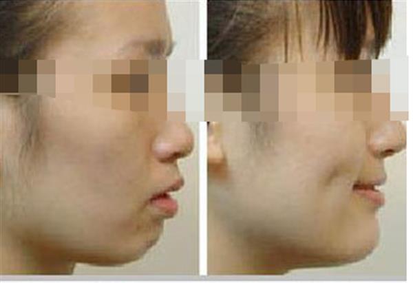 <a href=http://www.bolangguoji.com/listinfo-637-0.html target=_blank class=infotextkey>酒窩整形</a>手術(shù)是否安全