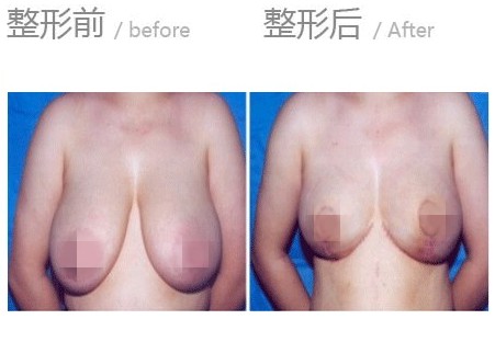 <a href=http://www.bolangguoji.com/listinfo-617-0.html target=_blank class=infotextkey>巨乳縮小</a>術(shù)的術(shù)前準備和術(shù)后護理