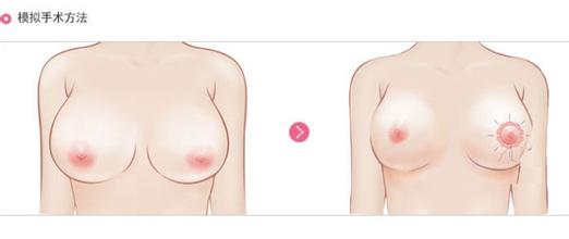 <a href=http://www.bolangguoji.com/listinfo-617-0.html target=_blank class=infotextkey>巨乳縮小</a>術的價格及手術準備工作