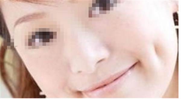 酒窩成形術(shù)的并發(fā)癥有哪些