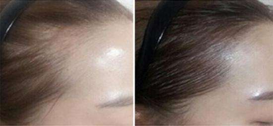 發際線過高或過低要如何改善