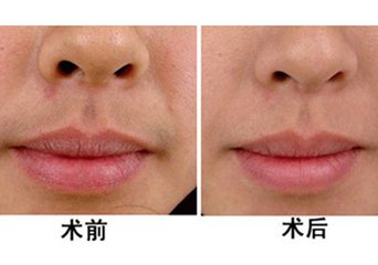 激光<a href=http://www.bolangguoji.com/listinfo-665-0.html target=_blank class=infotextkey>脫唇毛</a>會(huì)復(fù)發(fā)嗎