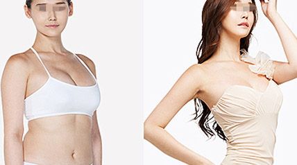 <a href=http://www.bolangguoji.com/listinfo-617-0.html target=_blank class=infotextkey>巨乳縮小</a>手術方式，術后恢復過程