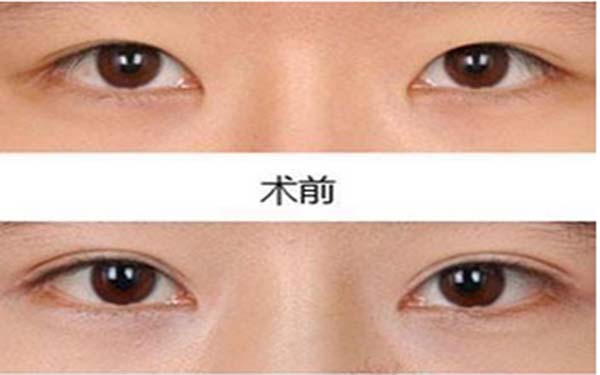 上海做重瞼術的價格