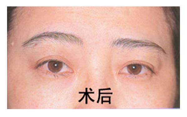 做完重瞼術后如何保養