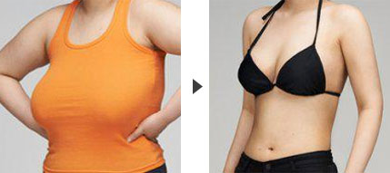 <a href=http://www.bolangguoji.com/listinfo-617-0.html target=_blank class=infotextkey>巨乳縮小</a>整形手術都有哪些方法呢