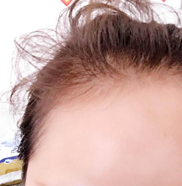如何判斷毛囊是否壞死