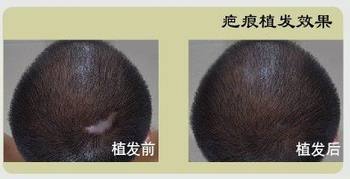 怎么讓頭上疤痕長頭發