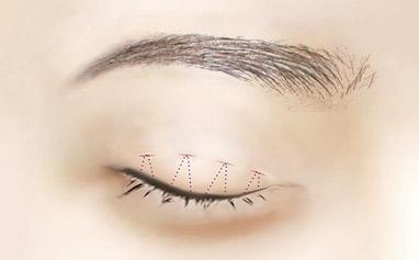 單眼皮適合什么<a href=http://www.bolangguoji.com/listinfo-724-0.html target=_blank class=infotextkey>雙眼皮</a>貼