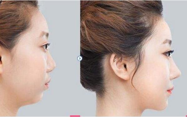 韓式<a href=http://www.bolangguoji.com/listinfo-737-0.html target=_blank class=infotextkey>隆鼻</a>有哪些優點