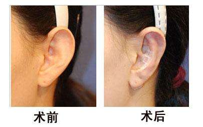 哪些人適合<a href=http://www.bolangguoji.com/listinfo-698-0.html target=_blank class=infotextkey>招風耳矯正</a>手術？