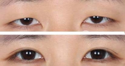 上眼瞼下垂手術費用