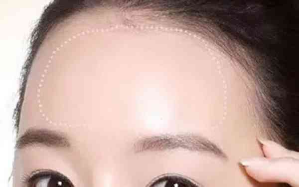 額頭填充多少錢